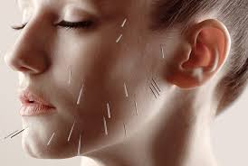 Facial Acupuncture Helen Turner