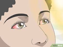 eye sunburn symptoms treatment