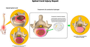 Spinal Cord Injury Repair