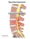 Spinale stenose behandlung