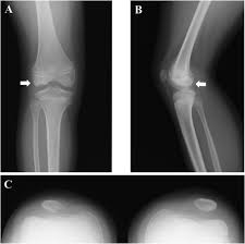 a case of nail patella syndrome with