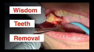 is wisdom teeth removal painful