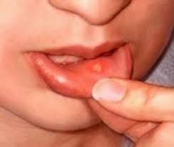 canker sores causes treatments