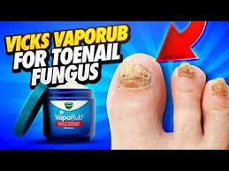 vicks vaporub for toenail fungus how