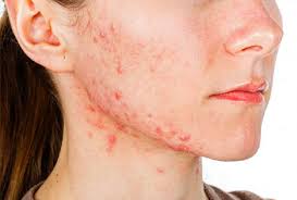 acne treatment specialist in nyc best