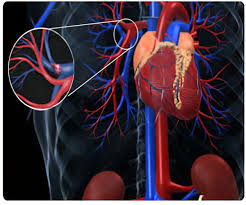 It is one of the most common cardiovascular diseases in the united states. Pulmonary Embolism