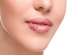 remes for cold sores around lips