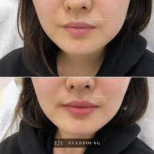 lip fillers vancouver lip injections