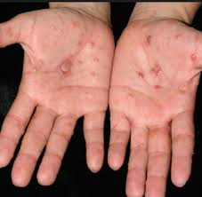 dyshidrotic eczema symptoms causes
