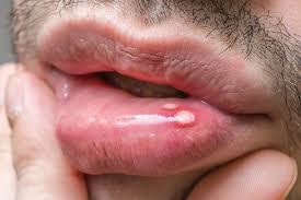 what causes canker sores 7 reasons
