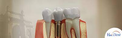 cost of dental implants in mumbai