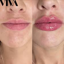 how much is 05ml of lip filler