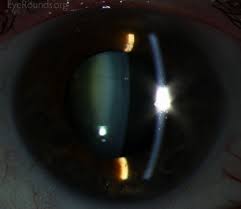 Anterior Subcapsular Cataract