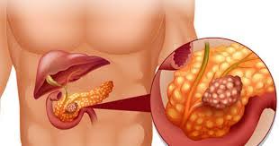 Pancreas transplant