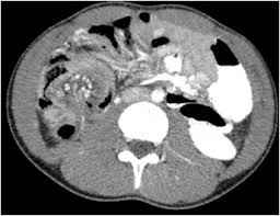 cecal lipoma and paraduodenal hernia