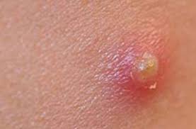 warts in woman
