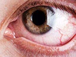 itchy eyes causes and treatment options