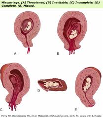 Decreased fetal movement over the past 24 hours. Hesi Ectopic Pregnancy Case Study Chloe Harris Diagram Quizlet