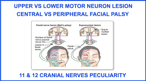 upper vs lower motor neuron lesion