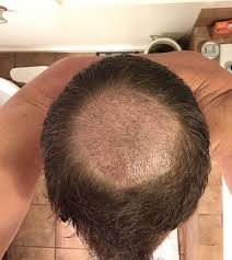 Check spelling or type a new query. Hair Transplant Timeline Over 6 000 Grafts Follow This Patient S Journey