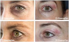8 plasma pen treatment before and after