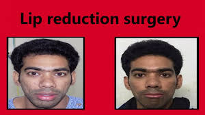 cleft lip surgery in mumbai india