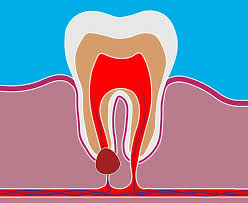 what is a dental cyst how is it