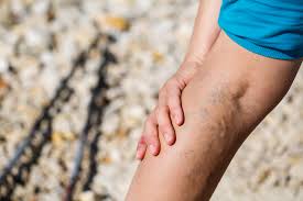 varicose veins what they are causes