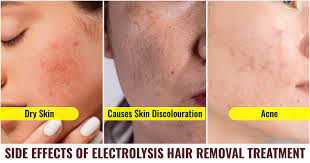 electrolysis hair removal treatment