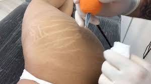 scar brazilian stretch mark tattoo