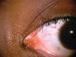 cornea and ocular surface