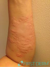 itchy rash pictures 6 most common