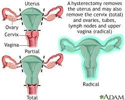 hysterectomy medlineplus cal