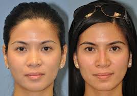 non surgical rhinoplasty chevy chase