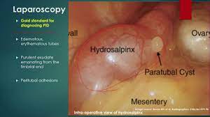 Melissa conrad pelvic inflammatory disease (pid) is an infection and inflammation of a woman's pelvic organs many women do not know they have pid, because they do not have any signs or symptoms. Pelvic Inflammatory Disease Youtube