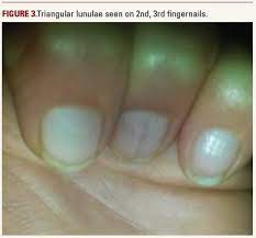 part iii nail patella syndrome