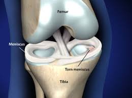 treating meniscus tears in plano
