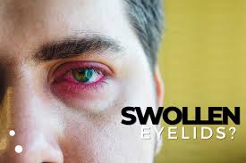 the many causes of swollen eyelids