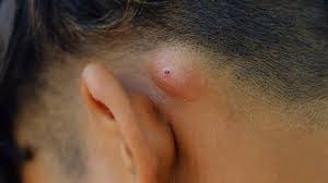 It is sometimes called a trichilemmal cyst although most people confuse it with a pilonidal cyst (which is a. Symptoms Of Staph Infection Everyday Health