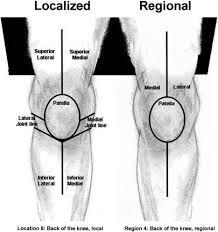 The Knee Pain Map Diagram Consists Of An Artists Drawing Of