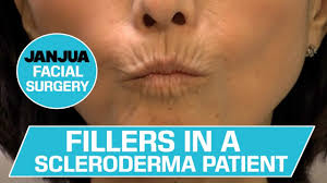 fillers in a scleroderma patient dr