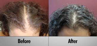 prp hair regrowth treatment client 7