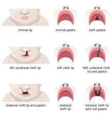 cleft lip and palate sabka dentist