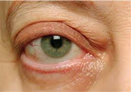 thyroid eye disease its causes and