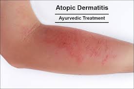 treatment of atopic dermais in ayurveda