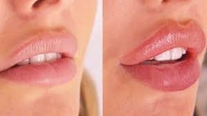 russian lip ideal body clinic