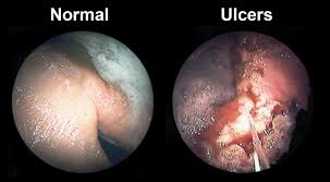 equine gastric ulcer syndrome