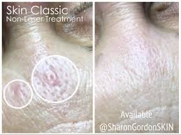sebaceous hyperplasia sharon gordon skin