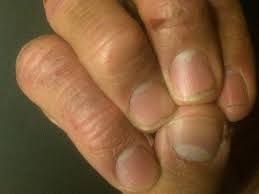 nail bed injuries types causes