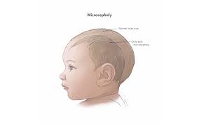 Five Things To Know About Microcephaly And Zika Virus